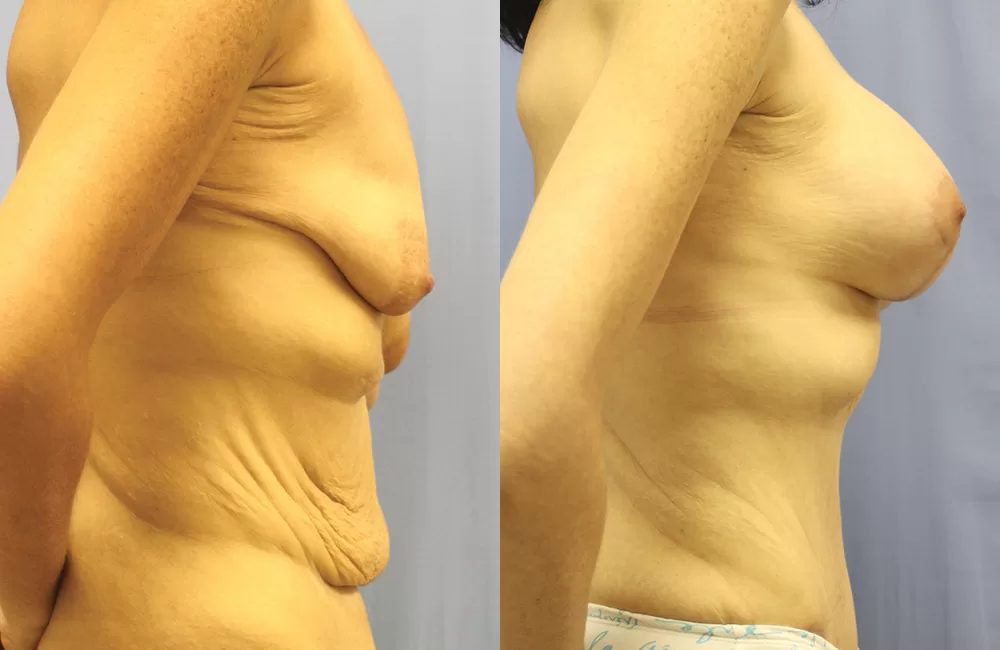 Moratis plastic surgery mommy makeover patient 4c