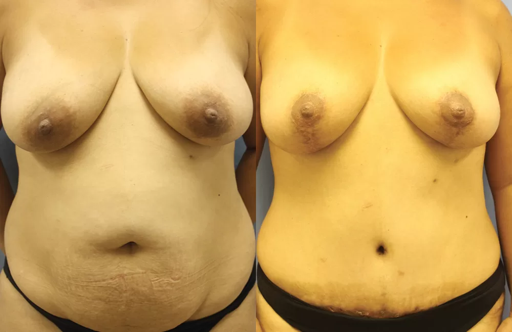 Moratis plastic surgery mommy makeover patient 5a