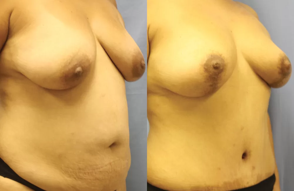 Moratis plastic surgery mommy makeover patient 5b