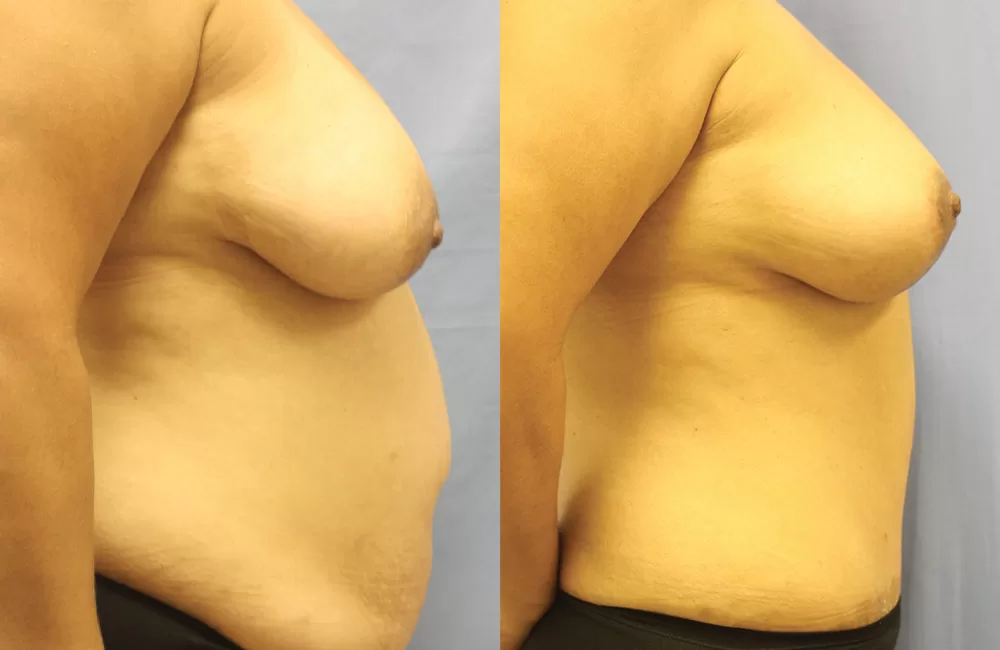 Moratis plastic surgery mommy makeover patient 5c