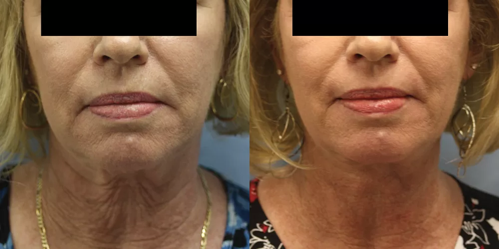 Moratis plastic surgery neck lift patient 1a