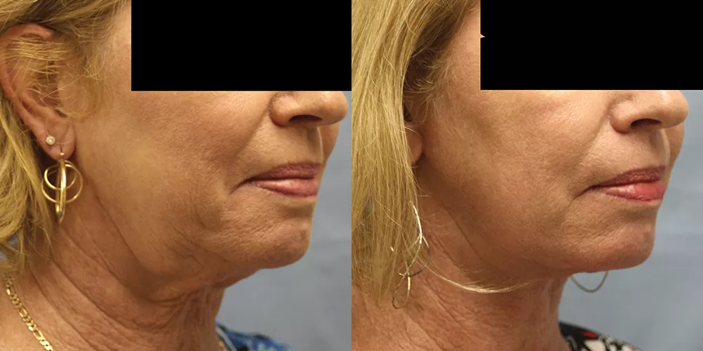 Moratis plastic surgery neck lift patient 1b