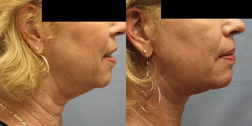 Moratis plastic surgery neck lift patient 1c