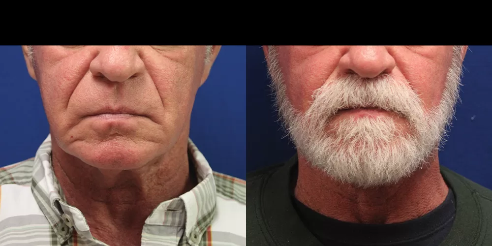 Moratis plastic surgery neck lift patient 2a