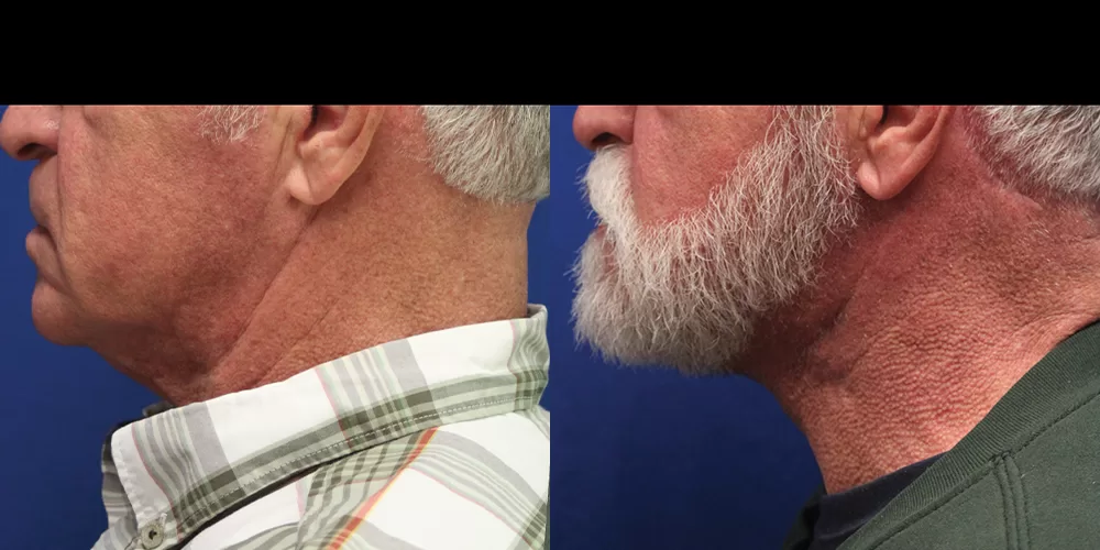Moratis plastic surgery neck lift patient 2b