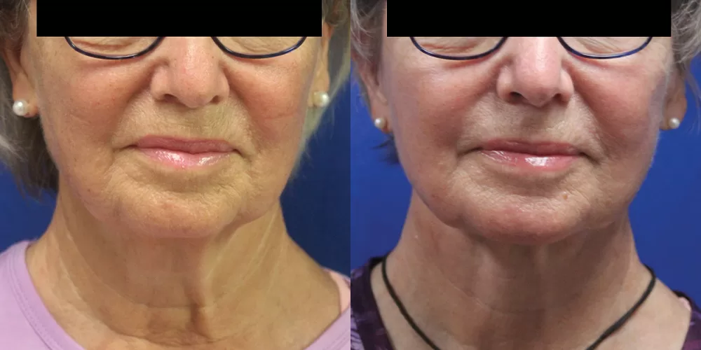 Moratis plastic surgery neck lift patient 3a