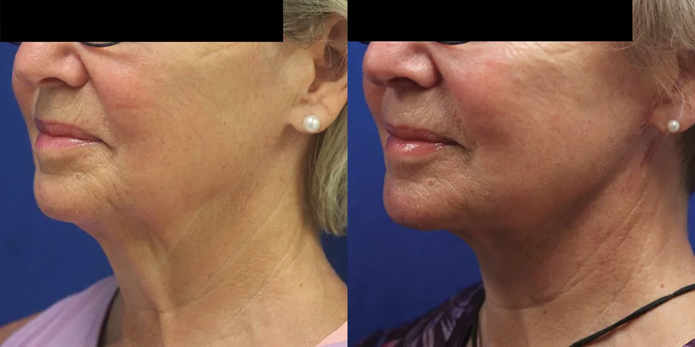 Moratis plastic surgery neck lift patient 3b