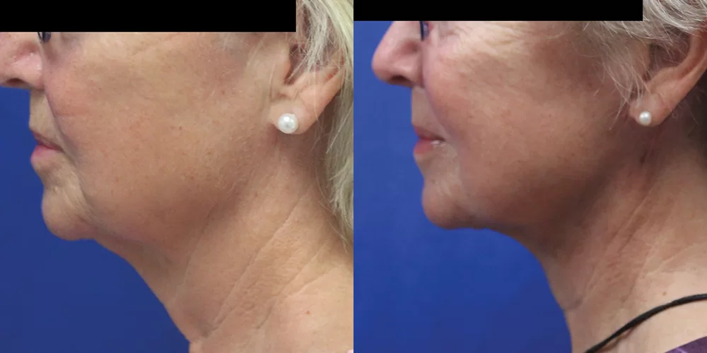 Moratis plastic surgery neck lift patient 3c