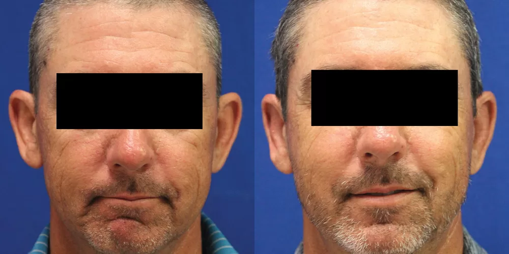 Moratis plastic surgery otoplasty patient 1a