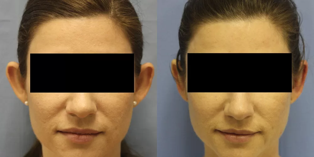 Moratis plastic surgery otoplasty patient 2a