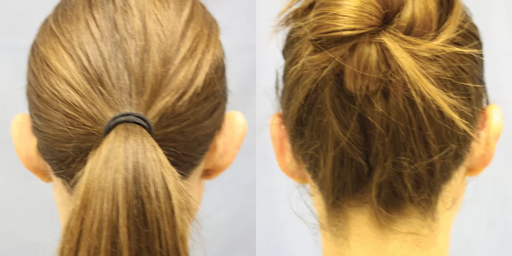 Moratis plastic surgery otoplasty patient 2b
