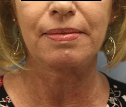 Moraitis hp before and after after | moraitis plastic surgery Moraitis hp before and after after