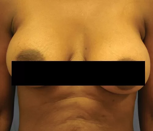 Moraitis procedure breast implant exchange before and after before