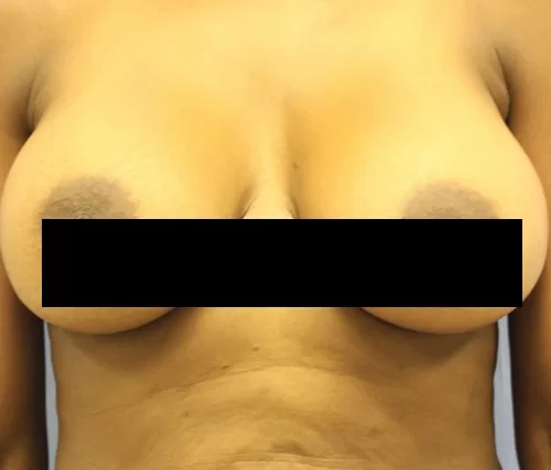 Moraitis procedure breast implant exchange before and after after