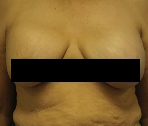 Moraitis procedure breast implant removal before and after before