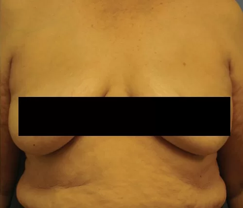 Moraitis procedure breast implant removal before and after after