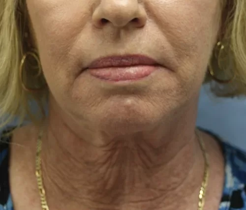 Moraitis procedure necklift before and after before