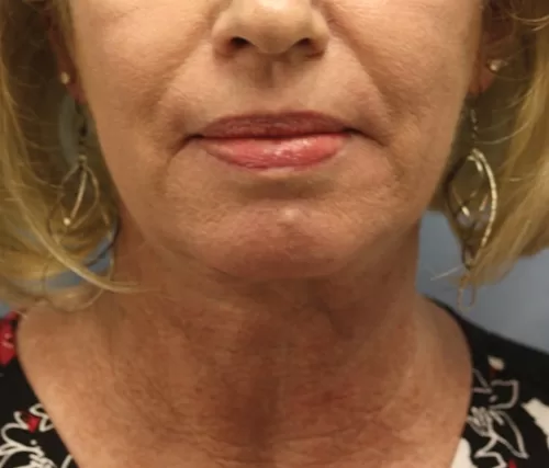 Moraitis procedure necklift before and after after