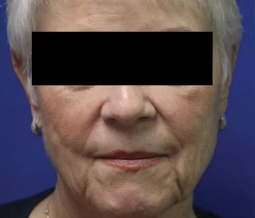 Moraitis procedure facelift before and after before