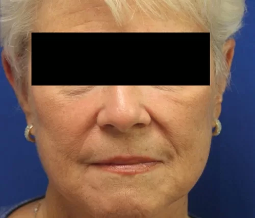 Moraitis procedure facelift before and after after