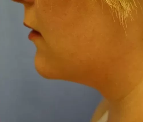 Moraitis procedure liposuction before  and after after