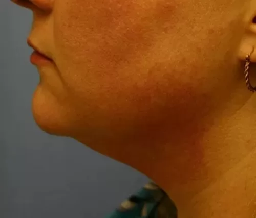 Moraitis procedure liposuction before  and after before
