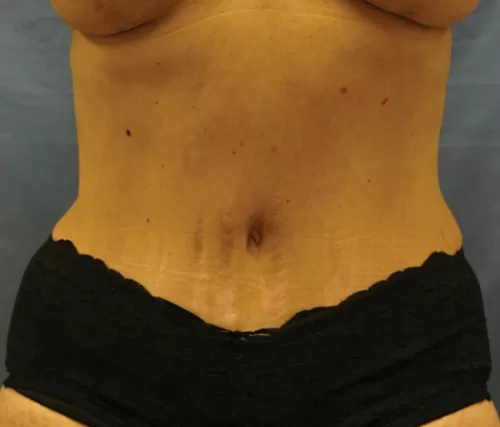 Moraitis procedure mommy makeover before and after after
