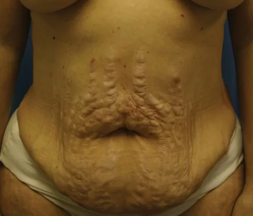 Moraitis procedure mommy makeover before and after before