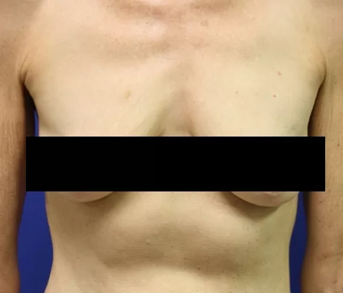 Moraitis before and after breast lift before