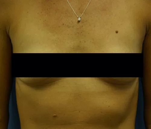 Moraitis before and after breast aug before