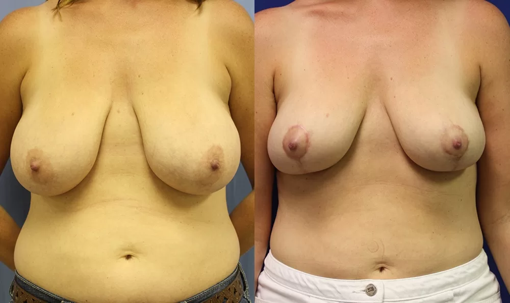 Beforeandafter 0017 18