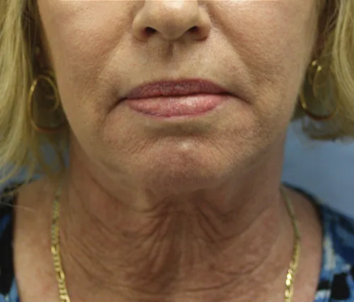 Moraitis before | moraitis plastic surgery Moraitis before