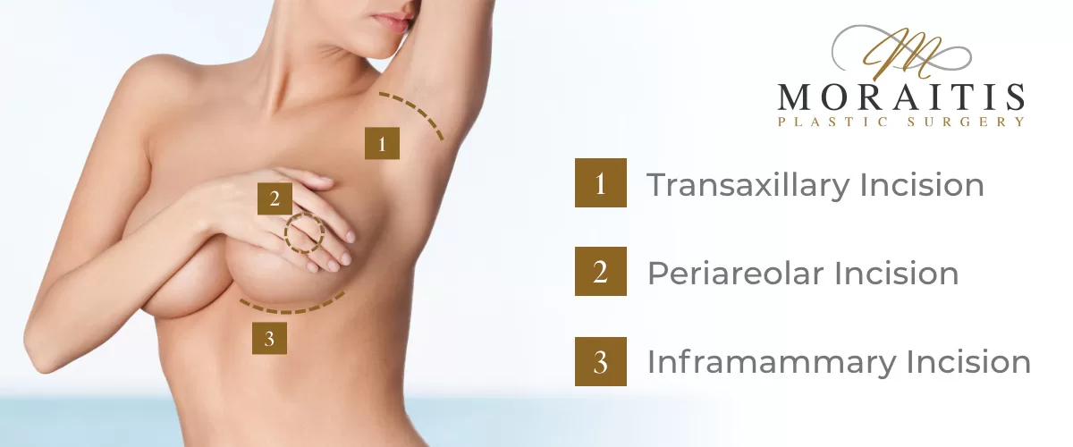 Moraitis incision types | moraitis plastic surgery Moraitis incision types