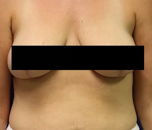 Moraitis procedure breast lift before andafter after