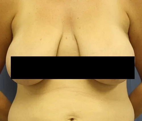 Moraitis procedure breast lift before andafter before